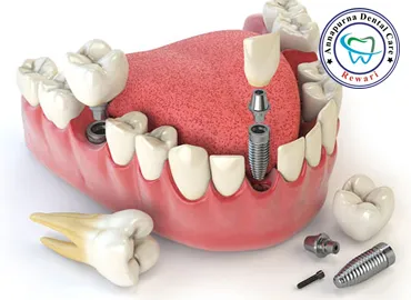 Dental Implants