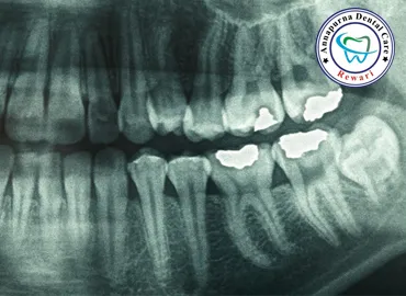 Dental X-Rays