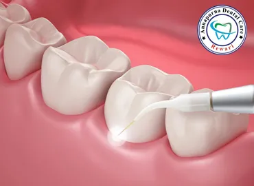Laser Dentistry