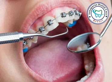 Orthodontic Braces