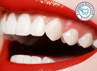 Teeth Whitening