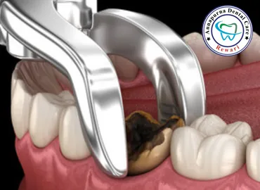Extractions